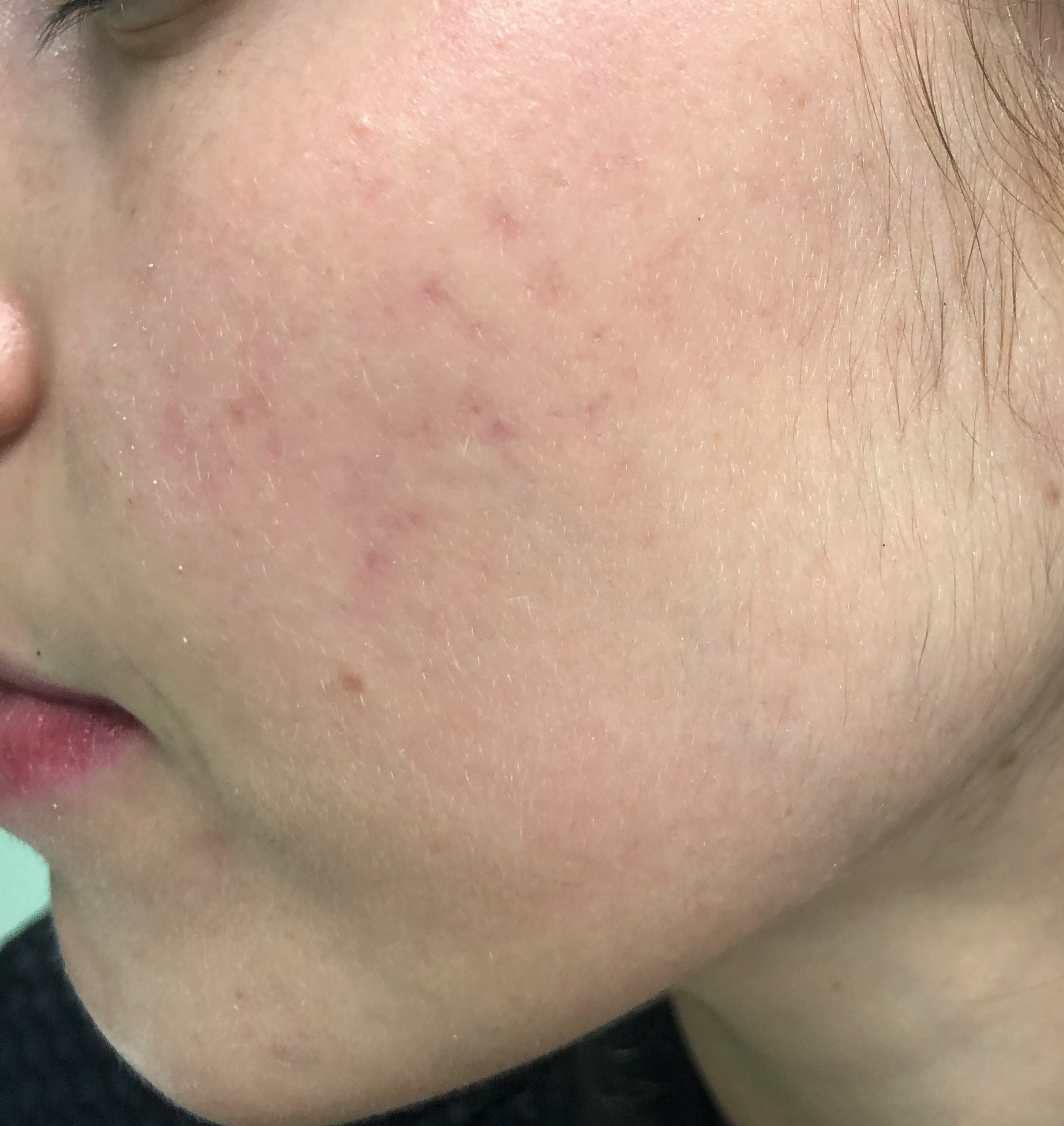 Casos de Acné - Antes y Después de Luz pulsada